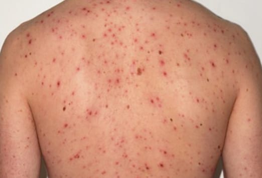 Check Out Signs Of HIV In Men You Should Never Ignore