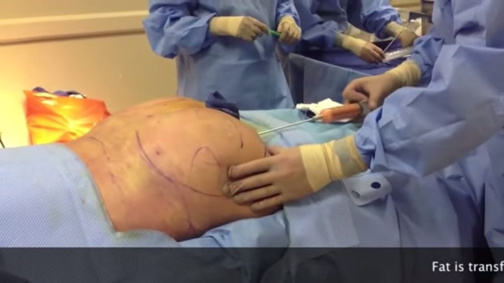 Doctor On The Run After Woman Dies During Butt Enlargement Surgery In Lagos