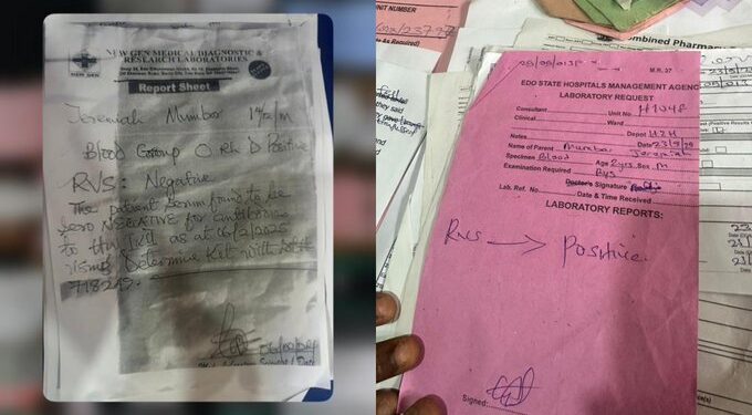 Edo Hospital Accused of Infecting Toddler with HIV Through 'Contaminated Blood Transfusion'