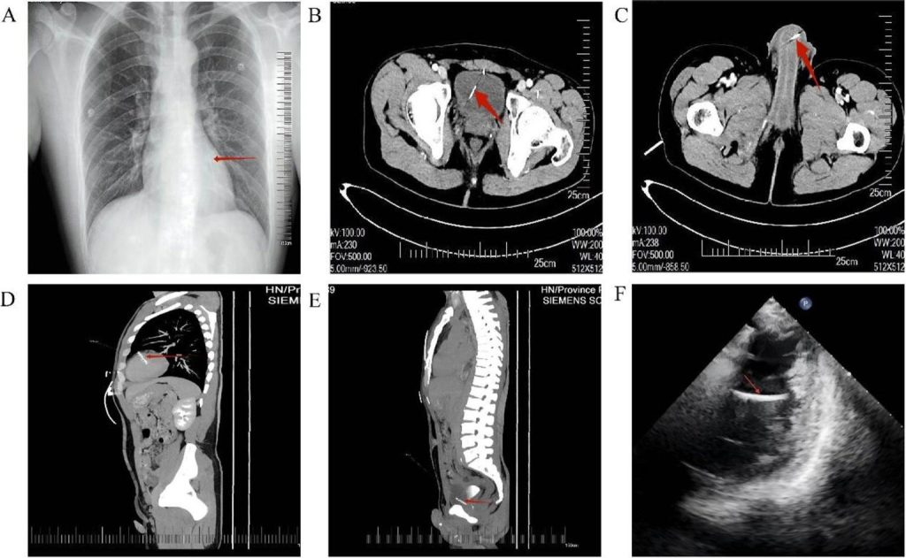 Doctors Confused After finding Shocking ‘Foreign Bodies’ Inside A Man’s Chest, Pelvis, Bladder, And Penis