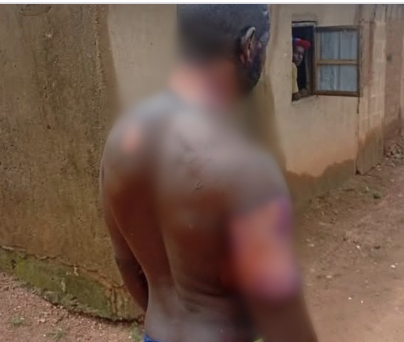 Nigerian Man Says He Still Loves His Wife After She Poured Hot Water On Him